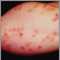 Dermatitis herpetiforme en el antebrazo