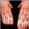 Epidermólisis bullosa, distrófica