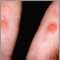 Examen de piel, PPD (brazo derecho) y Candida (izquierdo)