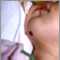 Hemangioma del mentón