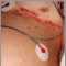 Herpes zoster diseminado