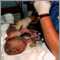 Cuidado del neonato después del parto