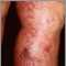 Telangiectasia en las piernas
