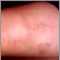 Tromboflebitis superficial