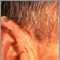 Queratosis actínica en el oído