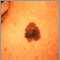 Melanoma del cuello