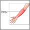 Celulitis en el brazo