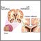 Cuerpo calloso del cerebro