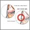 Dolor del ligamento colateral externo