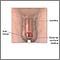 Estenosis meatal