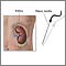 Biopsia renal