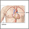 Arteriograma cardíaco