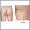 Celulitis
