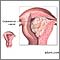 Cáncer endometrial