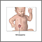Excisión de hemangioma