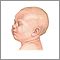 Llanto excesivo (0 a 6 meses)