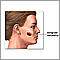 Melanoma maligno