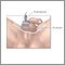 Ultrasonido testicular