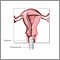Ultrasonido transvaginal